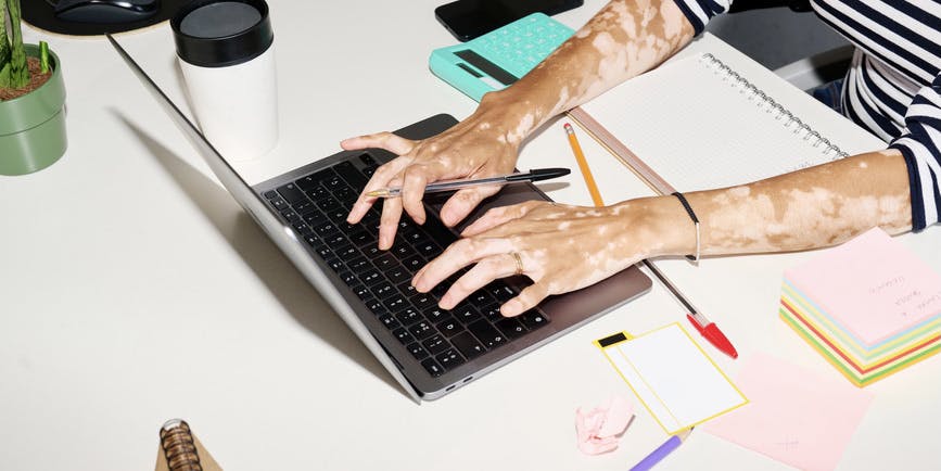Crop of business worker with vitiligo arms typing on her laptop with a pen in hand, Unrecognizable businesswoman working at white desk with calculator, mug of coffee, mobile phone, notebook and adhesive stickers.